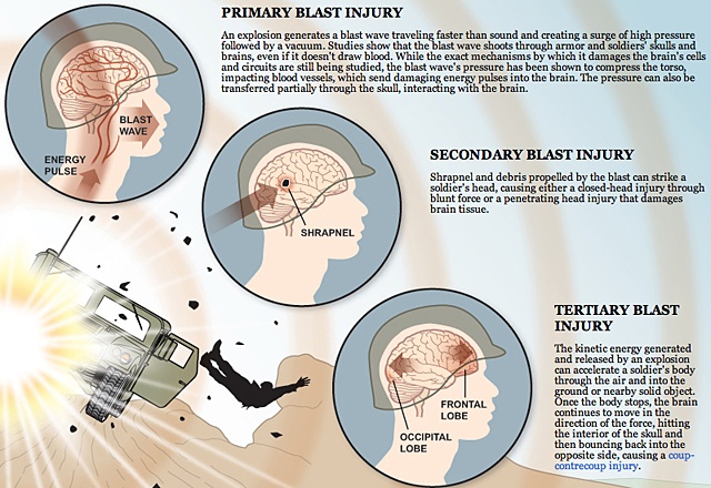 War and trauma: Learning the lessons  Pursuit by The University of  Melbourne